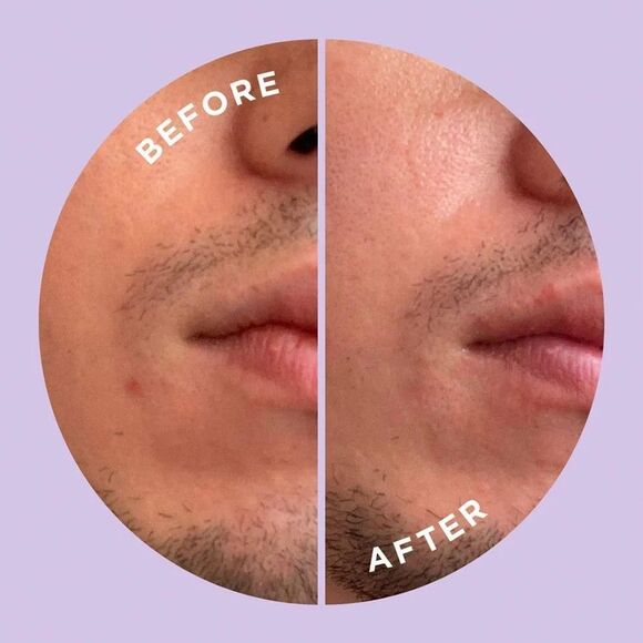 HYPERFADE by ZitSticka, Microdart Patch to Fade Post-Zit Dark Spots - 12 Count - Picture 7 of 8